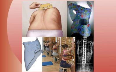 IV Curso Monográfico Manejo Interdisciplinar de la Escoliosis. Desde la sospecha a la cirugía.